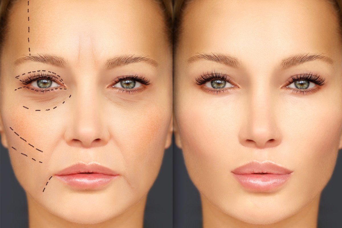65578a5aa6b9801888906128_62054dd85fdd5655174fc30f_72_DermalFillers